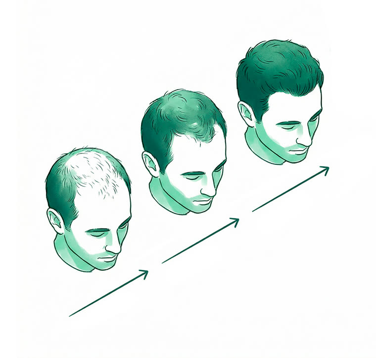 Editorial illustration, single MANUAL green monochrome palette: three male heads in sequence showing hair reco